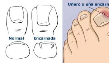 4 Tips para sacar uñas enterradas