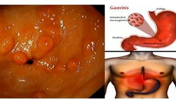 Agua con limón, agua de coco y té de linaza para quitar la gastritis para siempre