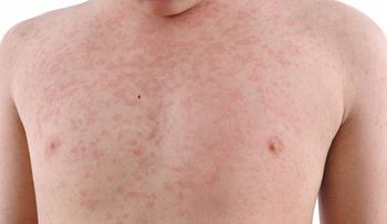 Nueva York declara "emergencia pública" por epidemia de sarampión en Brooklyn