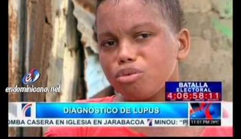 Joven que lucha contra el lupus (VIDEO)