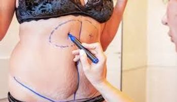 Liposucción: Riesgos y complicaciones