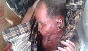 Indigente con gusanos en el cuerpo está debajo de elevado de la Kennedy