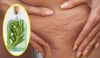 Alcohol de romero para acabar con la celulitis, varices, la gota y dolores musculares!!