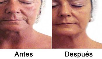 Tratamiento con plaquetas para rejuvenecer