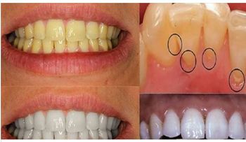 Aplica vinagre de manzana en tus dientes.¡Esto es lo que sucederá! 