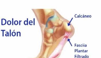Dolor en los talones y su tratamiento natural