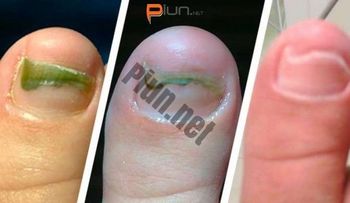 Elimina cualquier hongo de las uñas sin la necesidad de medicamentos solo aplicando esto