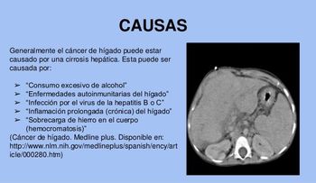 Advierten cáncer que produce consumo de alcohol 