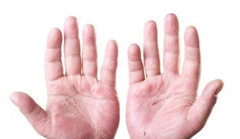 180 millones de personas padecen Psoriasis