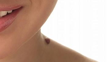 Cómo eliminar las verrugas de forma natural