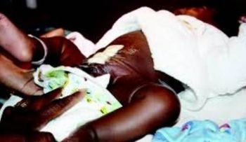 Operan recién nacido con 4 piernas en Sudáfrica