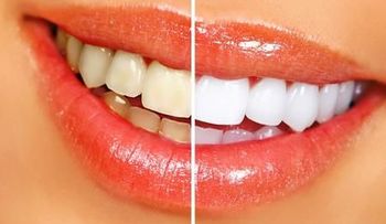 10 trucos caseros para lograr unos dientes perfectos