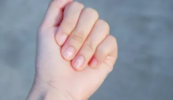 El aspecto de las uñas puede ser un síntoma de algunas enfermedades