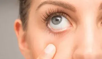 La alergia ocular del ojo seco, cómo diferenciarla 