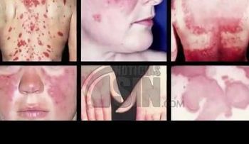 Más de 100 millones de personas afectadas por Lupus en el MUNDO