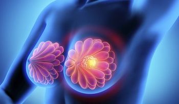 Síntomas del cáncer de mama y del cáncer de ovario