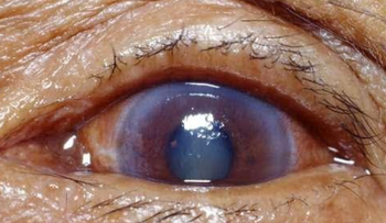 El glaucoma se roba silenciosamente la vista