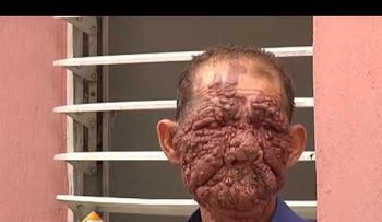 Dominicano con rostro de berrugas recibe ayuda