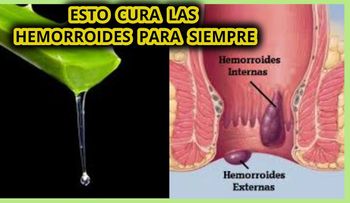 Son dolorosas y causan mucha picazón. Aquí tienes la manera natural de aliviar las hemorroides