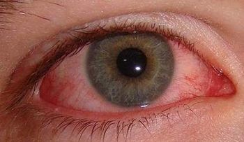  Cómo eliminar enrojecimiento de los ojos. 