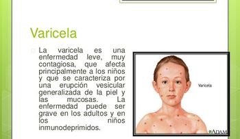  La varicela es una enfermedad sumamente contagiosa, afecta niños y personas mayores