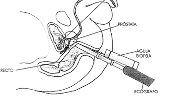 Biopsia de la próstata y sus complicaciones; consejos