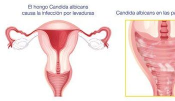 Micosis genital: Factores que contribuyen a la infección 