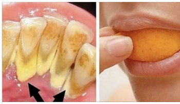 Elimina el sarro y blanquea tus dientes en 15 min con esta receta que un dentista jamás te dirá !