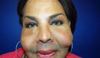 Muestran rostro de mujer deformado por cirugías estéticas