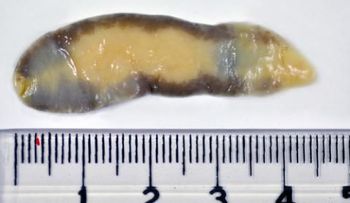 Trematodiasis: una enfermedad que puede infectar verduras, pescados y mariscos y que mata a 7 mil personas cada año