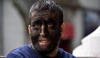 El síndrome del Hombre Lobo, la extraña enfermedad que se transmite de padres a hijos