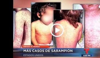 Casos de sarampión en aumento