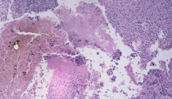 ¿Por qué el cáncer vuelve?