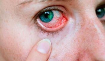 La abrasión o úlcera corneal