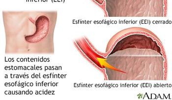 Enfermedad por reflujo gastroesofágico
