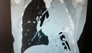 "Asesino invisible": un gas en muchos hogares podría causar cáncer de pulmón