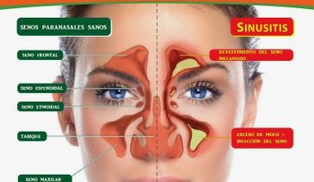 Remedios para la sinusitis que funcionan