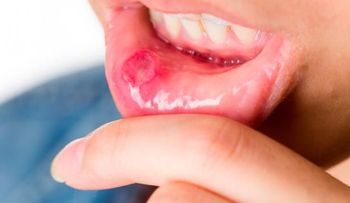 Un fármaco para tratar la psoriasis, demuestra ser muy eficaz en las úlceras orales 