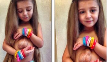 El extraño caso: niña que nació con el corazón por fuera del pecho