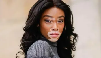 El vitiligo es una enfermedad de la piel que se desarrolla a partir de los 20 años; mayormente en las mujeres