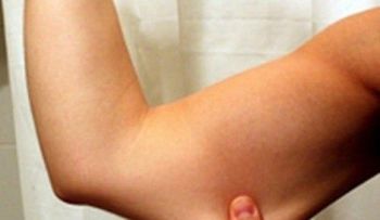 El mejor remedio para eliminar la flacidez de los brazos
