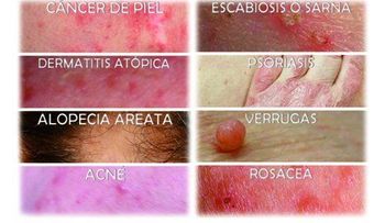 Más de 600 mil pacientes acuden anualmente al Dermatológico por enfermedades de la piel