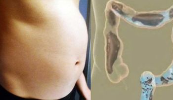 Potente remedio para limpiar el colon y bajar la hinchazón de la barriga