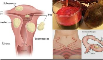 Un efectivo remedio para combatir miomas uterinos 
