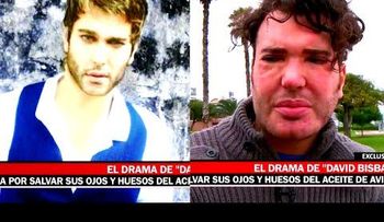 Quería parecerse a David Bisbal y le inyectaron aceite de avión (VIDEO)