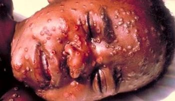 Alerta ante posibles casos de Ebola en Republica Dominicana