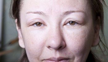 Causas y remedios naturales para una cara hinchada