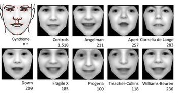 Crean un software capaz de diagnosticar trastornos genéticos por una foto