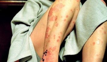 Terapia de blanqueamiento para tu piel