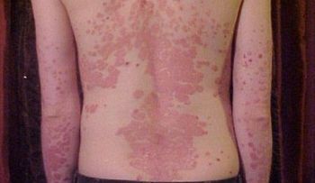 Psoriasis: Una enfermedad muy grave; imágenes de personas afectadas 